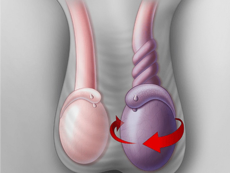 Xoắn tinh hoàn là một tình huống cấp cứu y khoa, cần được điều trị ngay lập tức