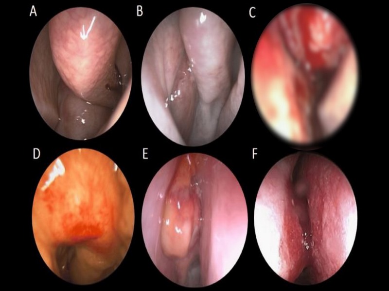 Hình ảnh khối u hốc mũi qua nội soi