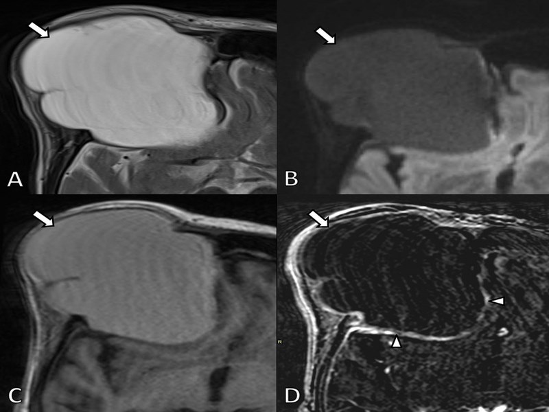 MRI rất hữu ích trong việc chẩn đoán u nhầy xoang trán