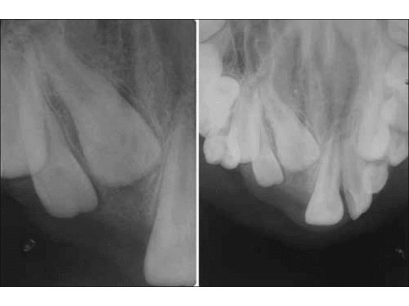 U kết hợp vùng răng cửa ngầm hàm trên