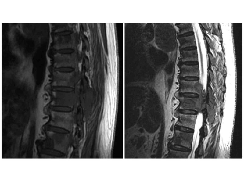 MRI cho thấy hình ảnh khối u trong ống sống