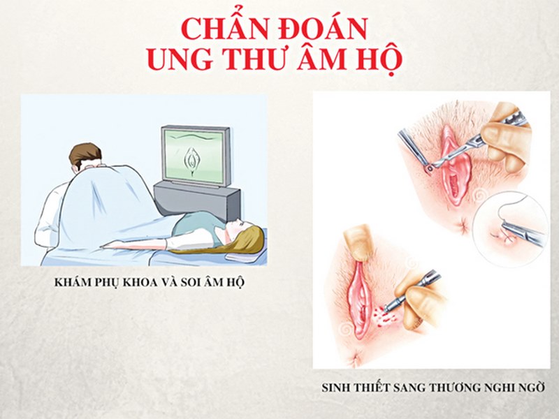 Tìm hiểu chung về ung thư âm hộ