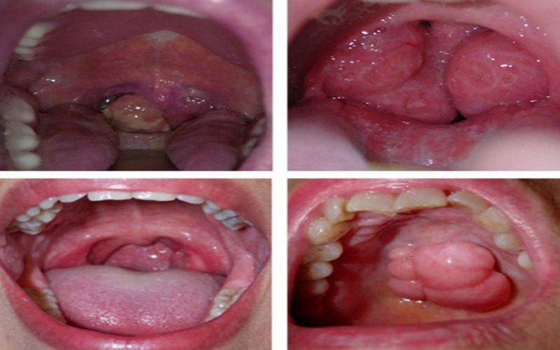 Có vết loét, phồng rộp hoặc khối u ở vùng amidan nên gặp bác sĩ khám