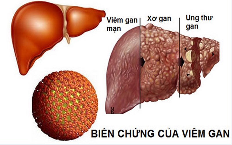 Biến chứng của viêm gan