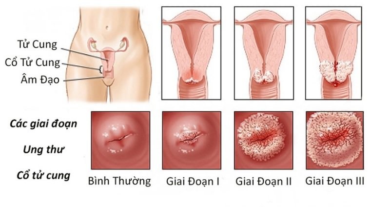 Những ai có nguy cơ mắc bệnh