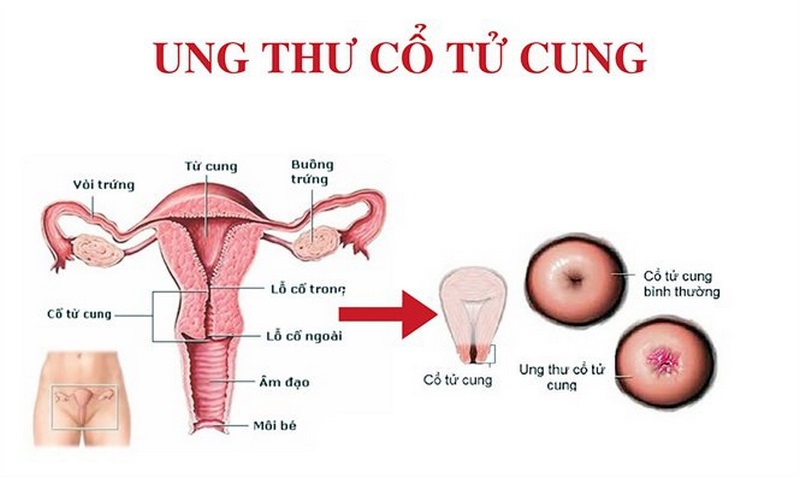 Tìm hiểu chung về ung thư cổ tử cung