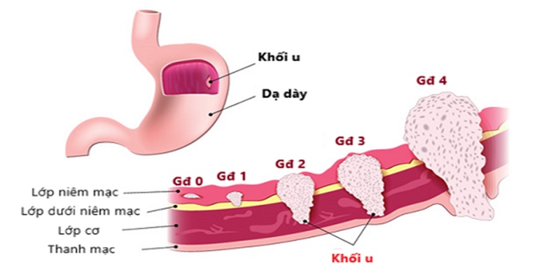 Ung thư dạ dày được chia thành nhiều giai đoạn