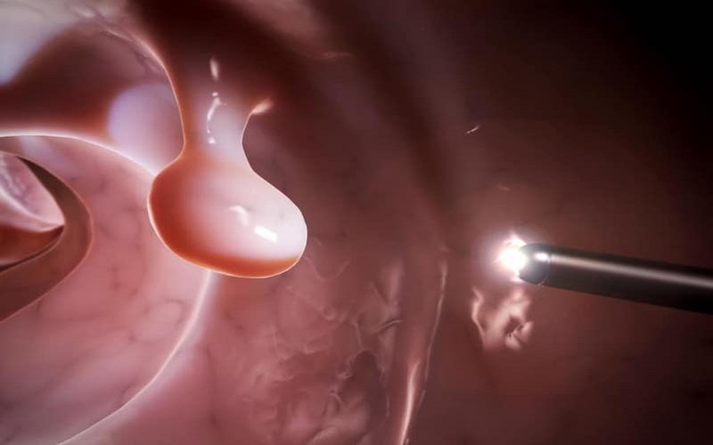 Khối u ác tính có thể bắt nguồn từ các polyp lành tính ở đại tràng