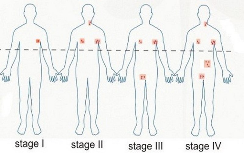 Ung thư hạch được chia thành 4 giai đoạn với mức độ bệnh khác nhau