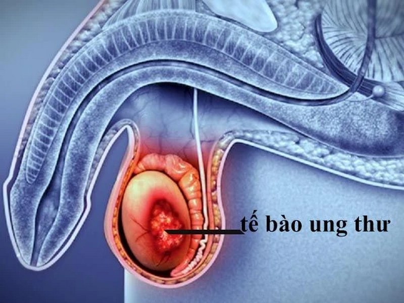 Chế độ sinh hoạt dành cho người bệnh