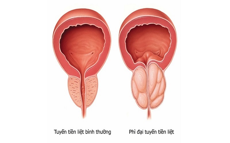 Tình trạng tăng sinh bất thường tuyến tiền liệt ở nam giới dẫn đến u tiền liệt tuyến