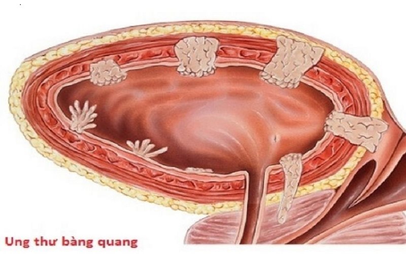 Ung thư bàng quang là loại bệnh ác tính và đứng thứ nhì trong số các bệnh lý ung thư