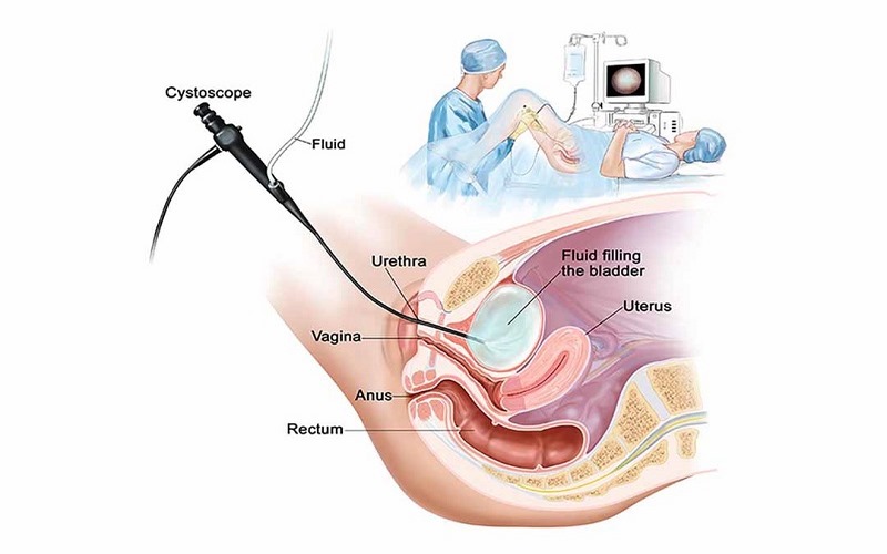 ống nội soi sẽ được đưa vào niệu đạo, phát hiện các bất thường