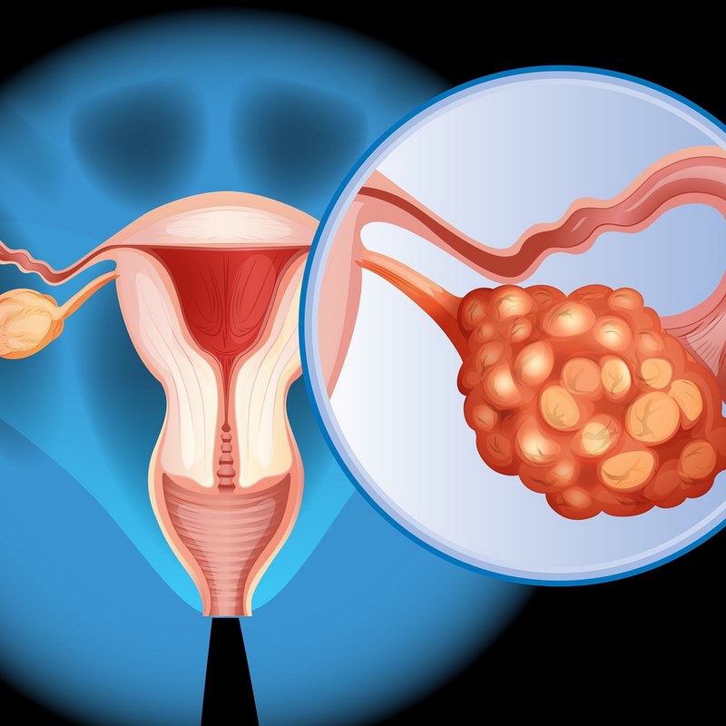 Phụ nữ có tiền sử gia đình với ung thư buồng trứng dễ mắc bệnh