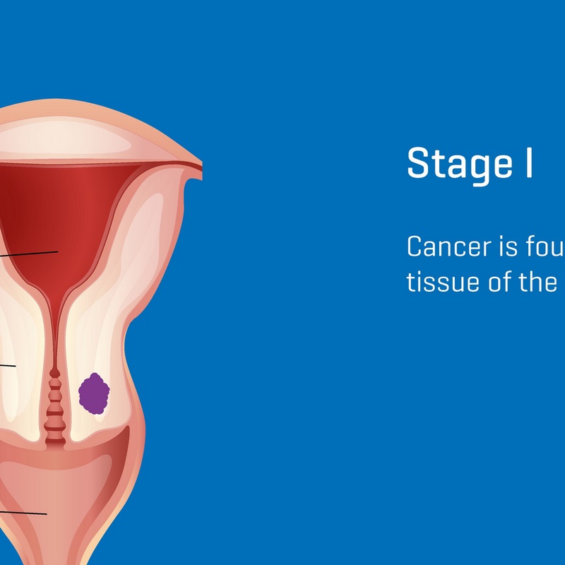 Ung thư cổ tử cung giai đoạn 1 có nhiều triệu chứng