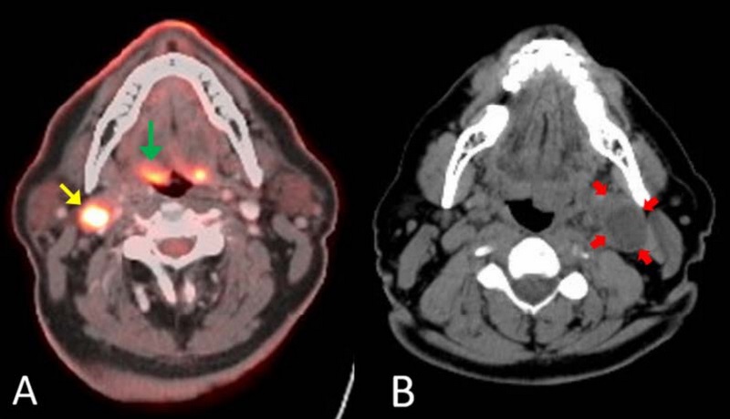 CT hay PET CT cho hình ảnh chi tiết về khối u