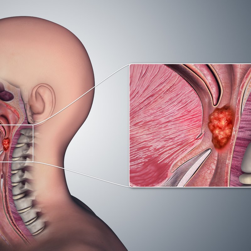 Tìm hiểu chung về ung thư hầu họng