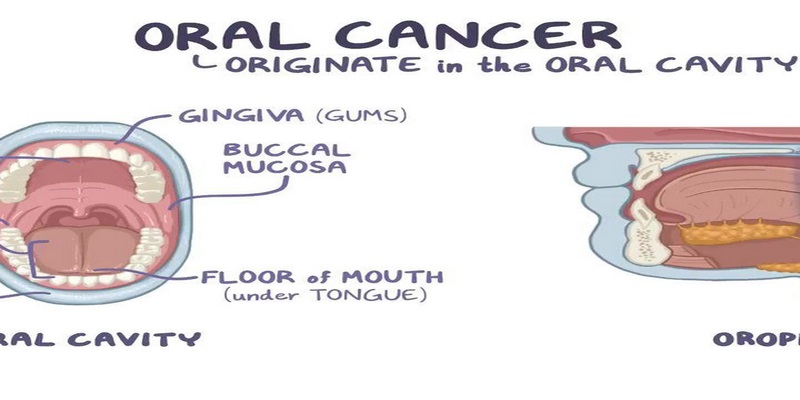 Ung thư khoang miệng là gì?