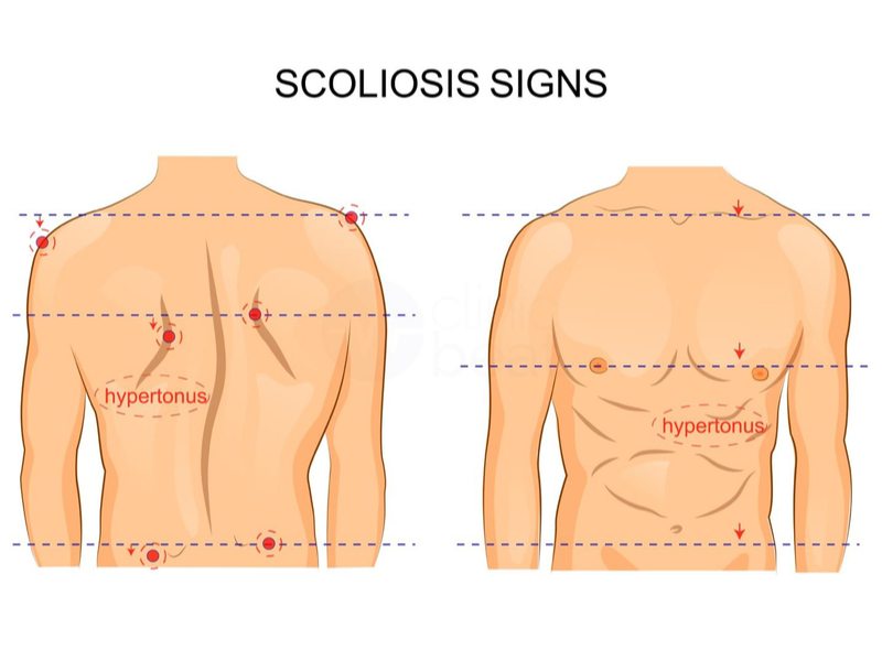 Bất thường các mốc giải phẫu 2 bên cơ thể gợi ý tình trạng vẹo cột sống