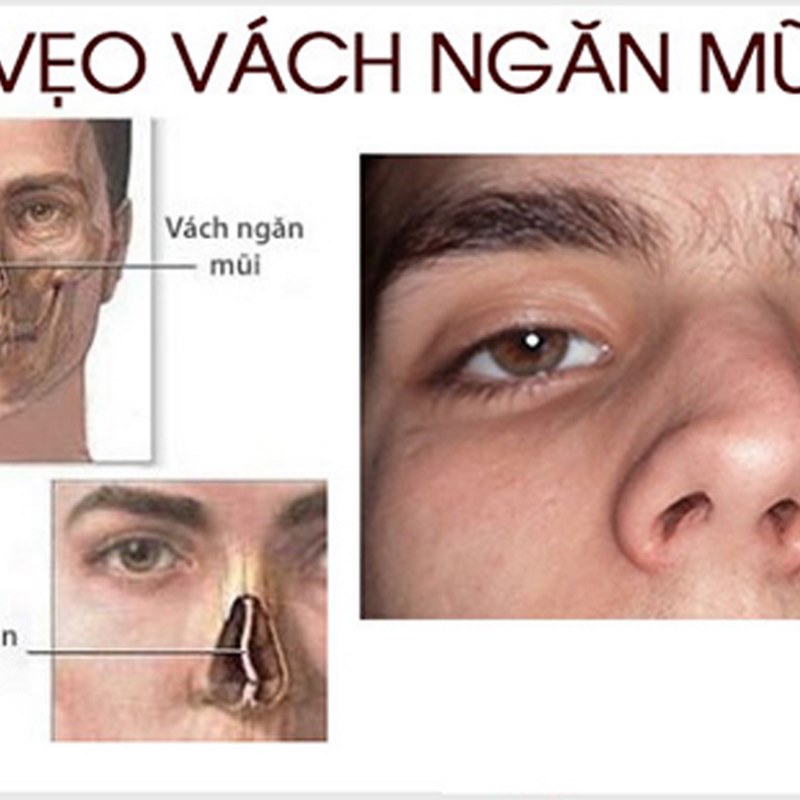 Nếu trong gia đình có người mắc bệnh vẹo vách ngăn mũi, khả năng cao bạn sẽ bị di truyền yếu tố này