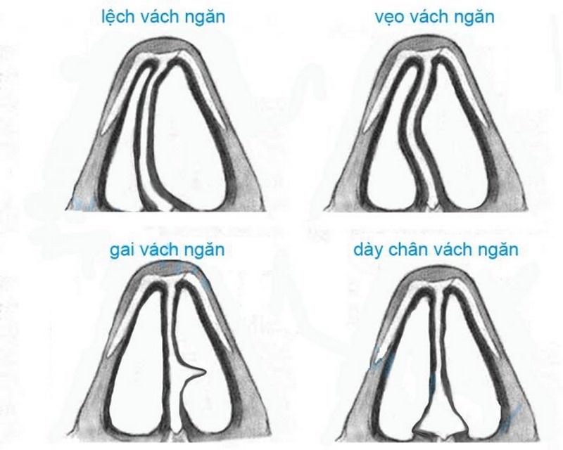 Tránh tiếp xúc với các chất gây kích ứng như bụi, hóa chất hoặc hút thuốc lá, cồn