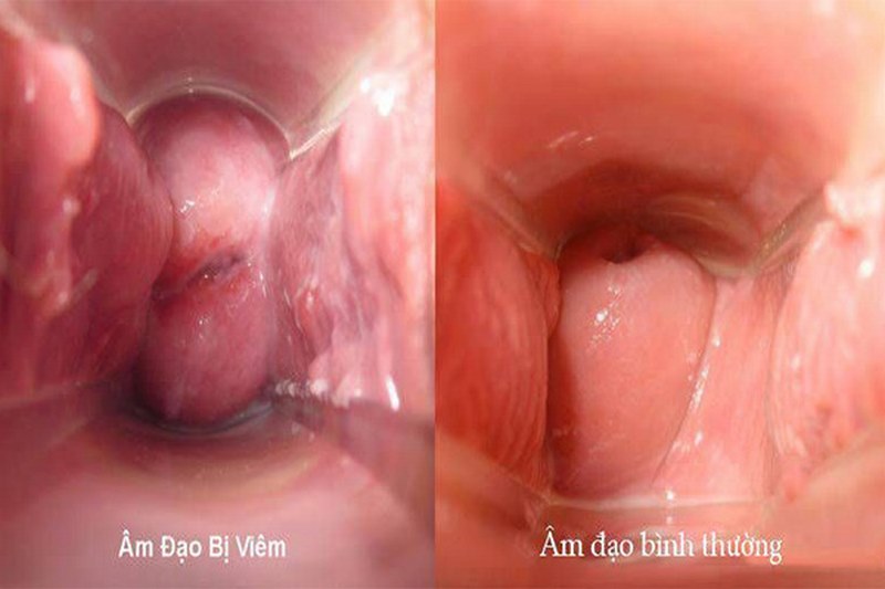 Tìm hiểu chung về viêm âm đạo