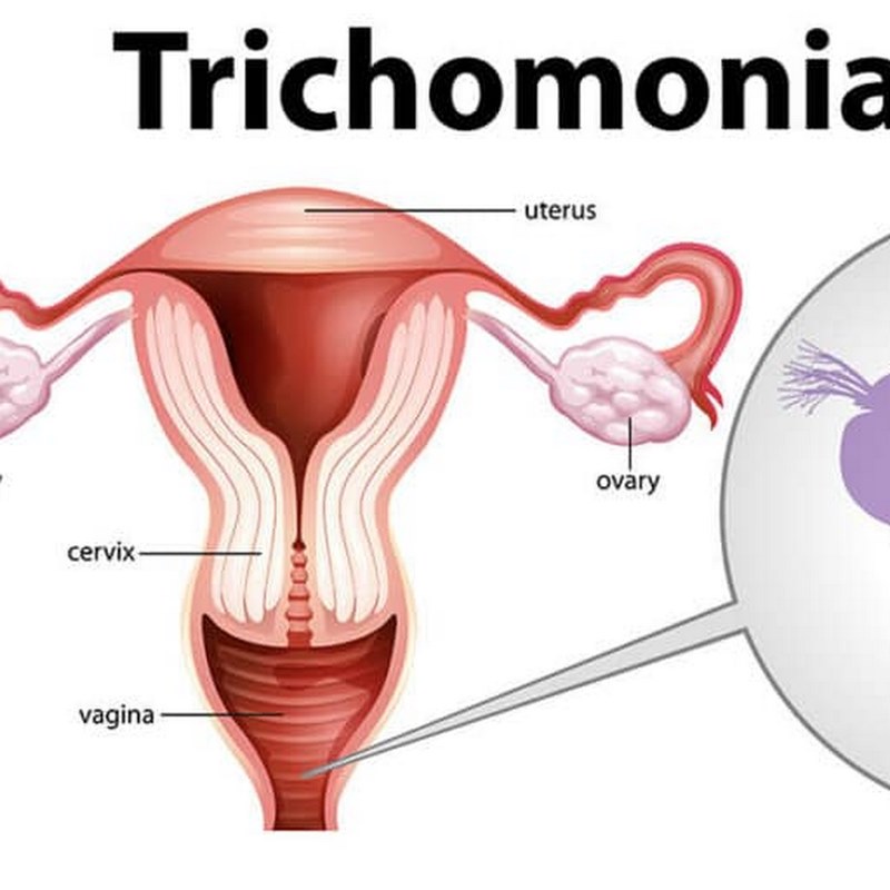 Tìm hiểu về viêm âm đạo do Trichomoniasis