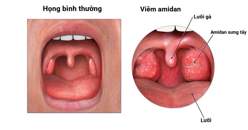 Tìm hiểu chung về viêm amidan