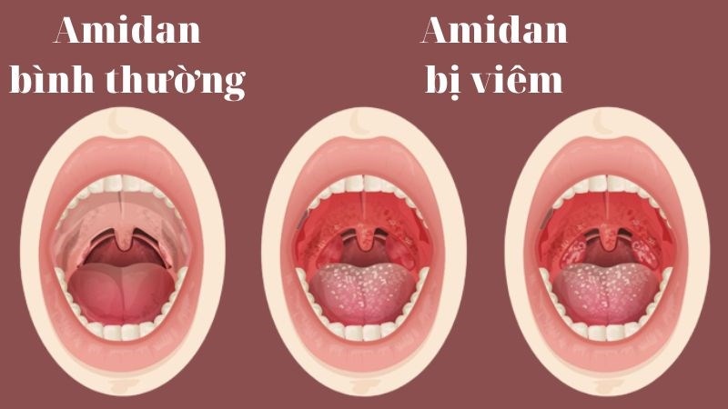 Bác sĩ sẽ nhìn vào họng để kiểm tra viêm amidan