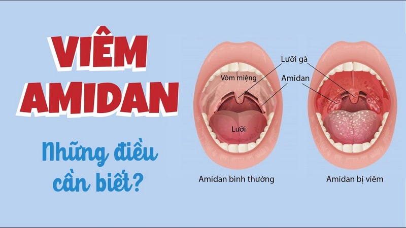 Để ngăn ngừa sự lây nhiễm và tái phát viêm amidan, hãy duy trì vệ sinh cá nhân sạch sẽ