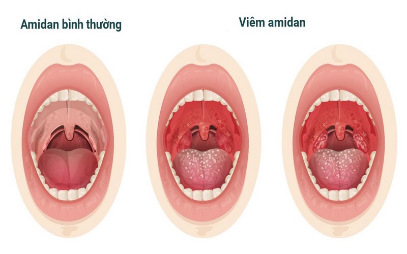 Viêm amidan xơ teo là một dạng amidan mãn tính thường gặp