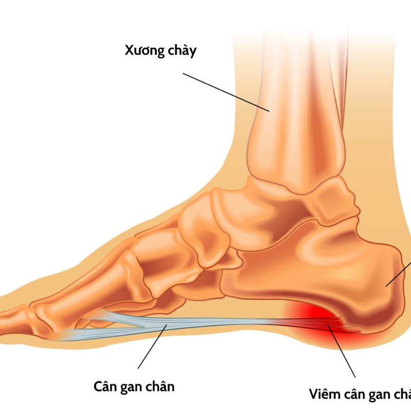 Viêm cân gan chân: Nguyên nhân và cách điều trị hiệu quả