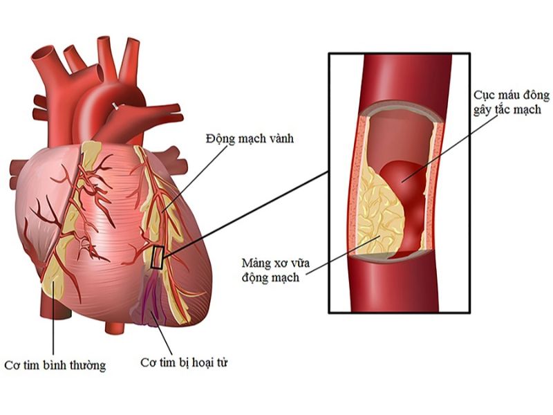 Viêm cơ tim dẫn đến hoại tử cơ tim, nguy hiểm tính mạng bệnh nhân.