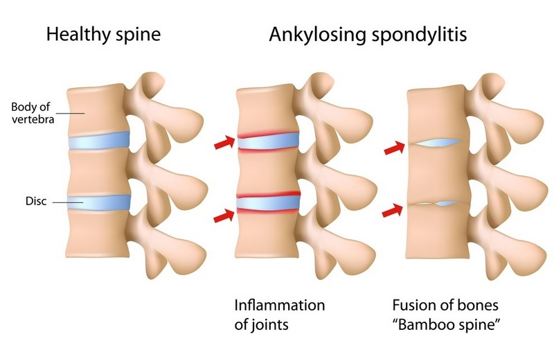 Tìm hiểu chung về bệnh viêm cột sống dính khớp