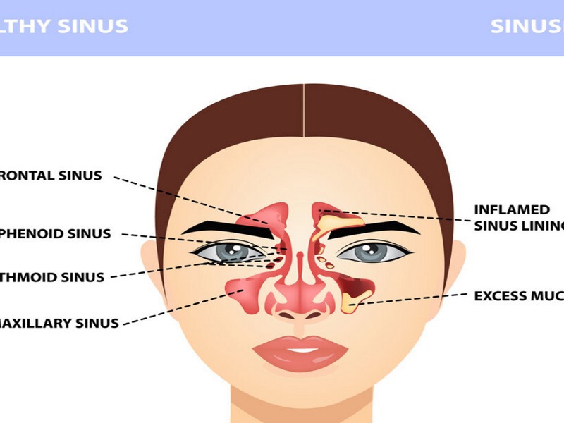 Viêm đa xoang là gì?