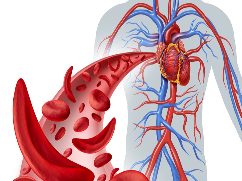 Thiếu máu hồng cầu hình liềm có thể gây ra viêm đại tràng thiếu máu cục bộ