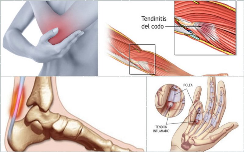 Viêm gân có thể xảy ra ở nhiều vị trí trên cơ thể