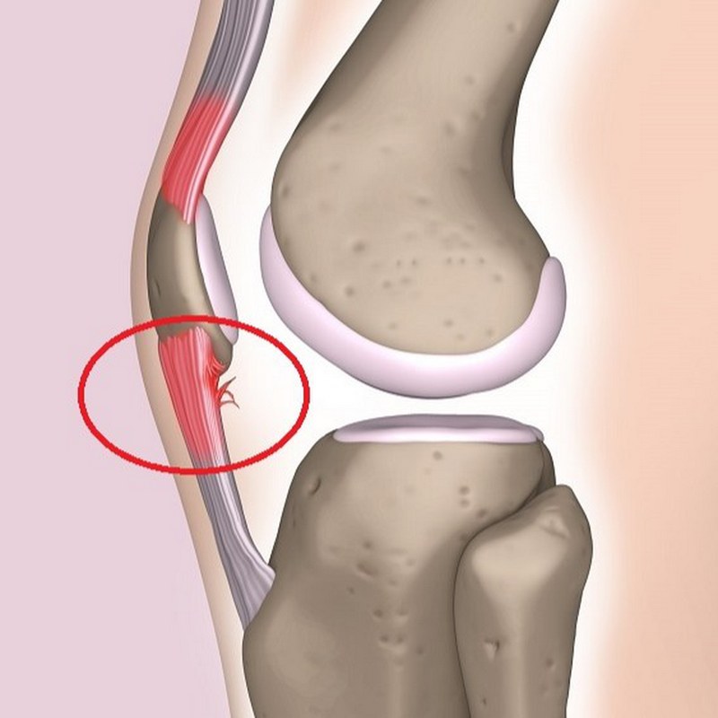 Viêm gân bánh chè là gì? Triệu chứng và cách điều trị