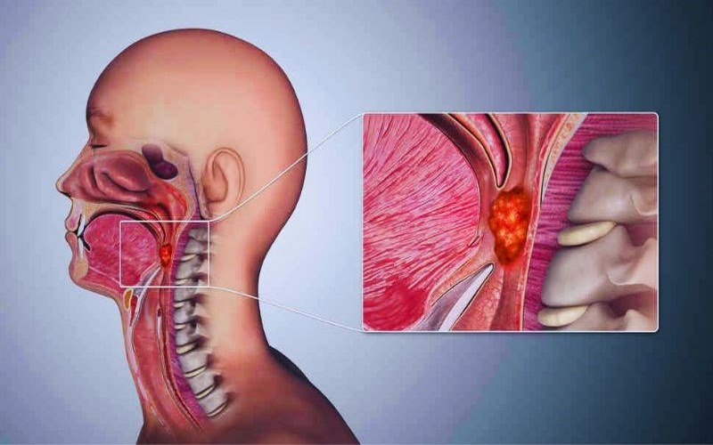 Đau họng kéo dài là triệu chứng viêm họng mạn tính