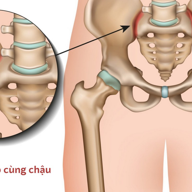 Nguyên nhân dẫn đến viêm khớp cùng chậu