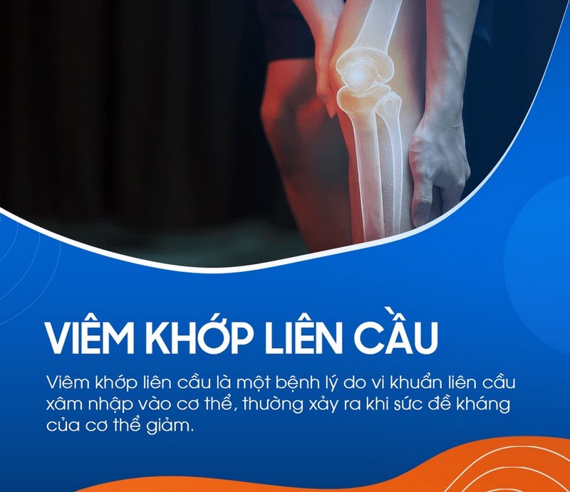 Viêm khớp liên cầu: Nguyên nhân và phương pháp điều trị