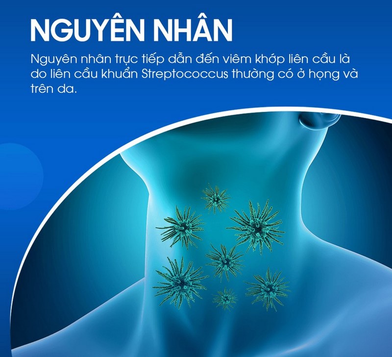 Nguyên nhân dẫn đến viêm khớp liên cầu