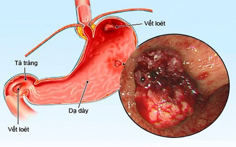 viêm loét dạ dày là bệnh rất phổ biến