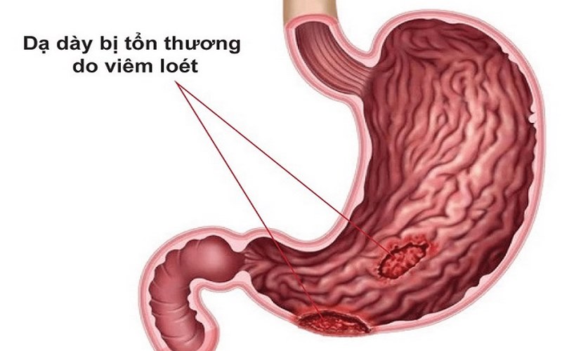 Người bệnh bị đau vùng thượng vị