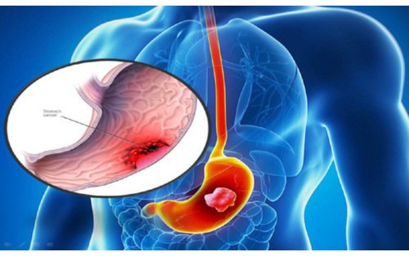 Viêm loét dạ dày mãn tính có thể do vi khuẩn Helicobacter pylori gây nên