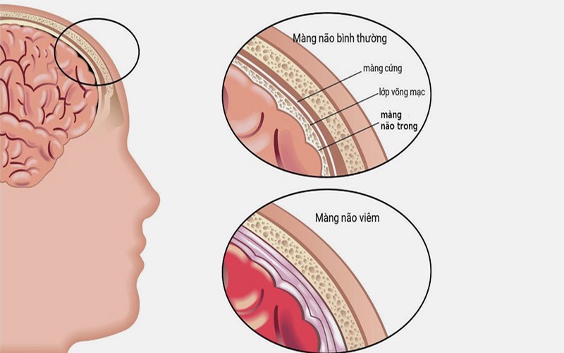 Bệnh làm cho các lớp mô xung quanh não bị nhiễm trùng