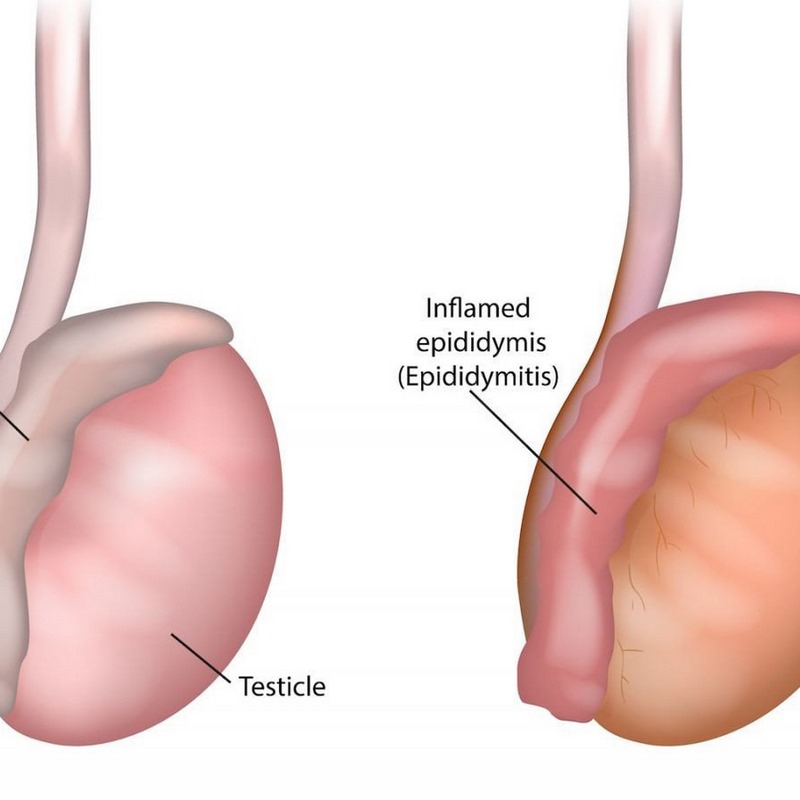Tìm hiểu về viêm mào tinh hoàn