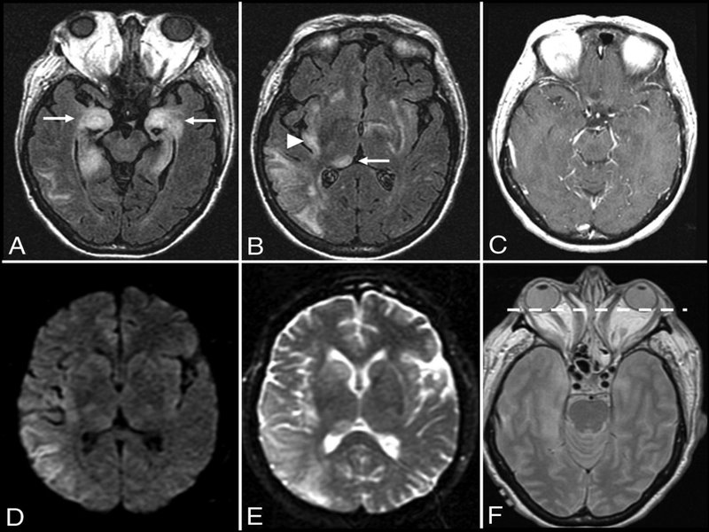 Chụp MRI giúp phát hiện các đặc điểm tổn thương não của viêm não tự miễn