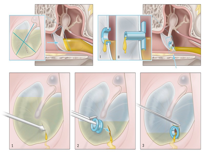 Phẫu thuật dẫn lưu giúp thoát dịch và giảm áp trong tai