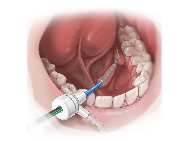 Nội soi tuyến nước bọt vừa có giá trị chẩn đoán vừa có giá trị điều trị